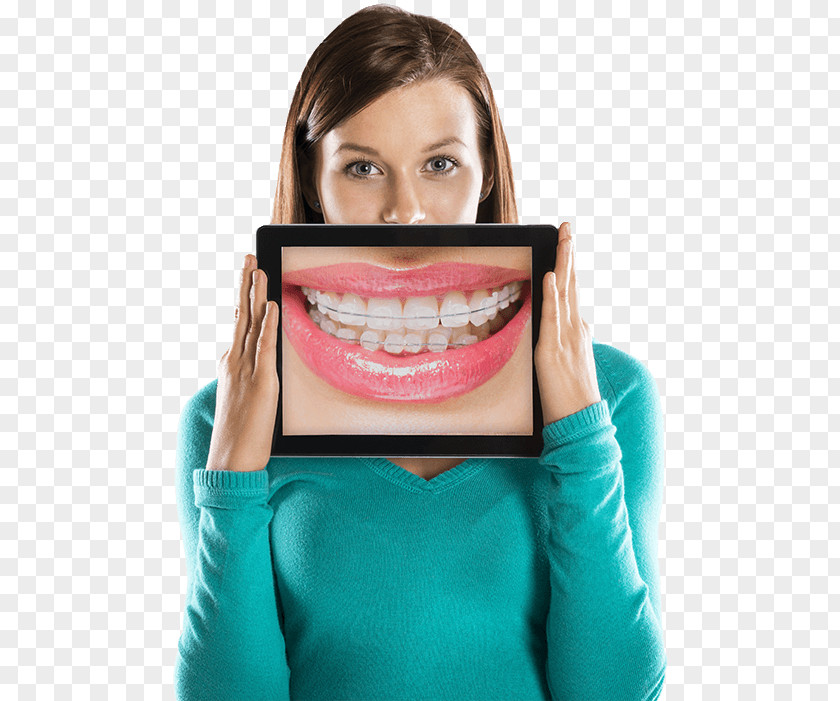 Braces Cosmetic Dentistry Orthodontics Dental PNG