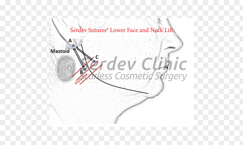 Serdev Suture Surgical Surgery Rhytidectomy Superficial Muscular Aponeurotic System PNG