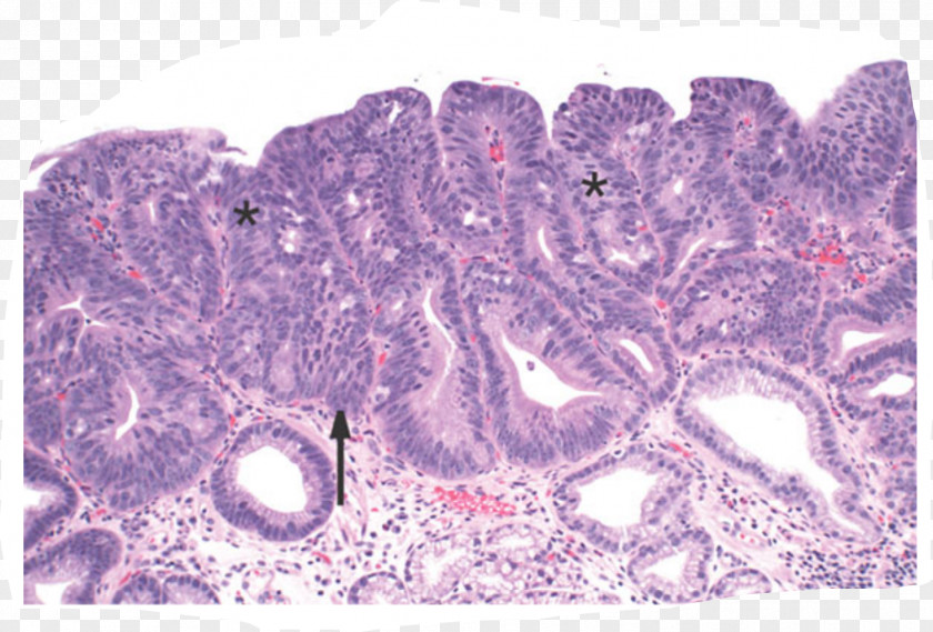 Barrett's Esophagus Intestinal Metaplasia Epithelium Adenocarcinoma PNG