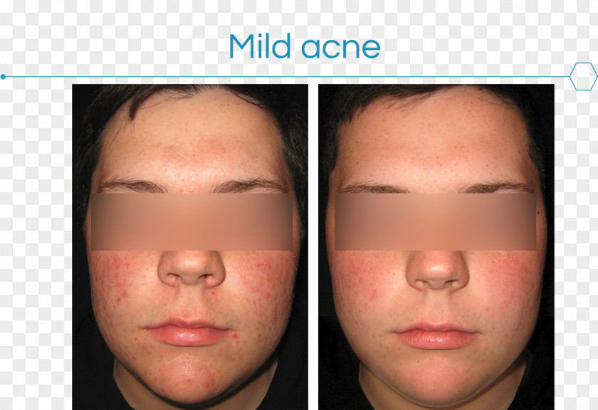 Acne Skin Face Dermatology Cosmetics PNG