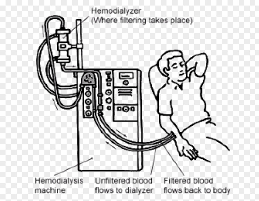 Excretory System Hemodialysis Kidney Failure Chronic Disease PNG