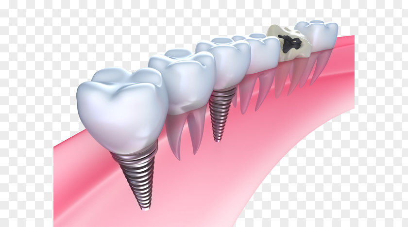 Bridge Dental Implant Dentistry PNG