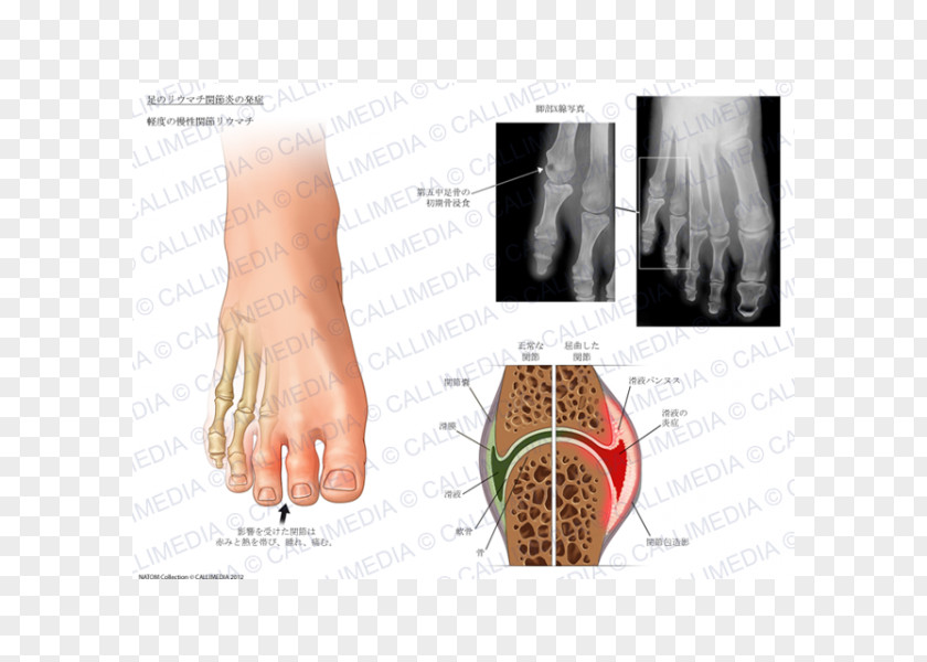 Nail Arthritic Pain Rheumatoid Arthritis Foot Joint PNG