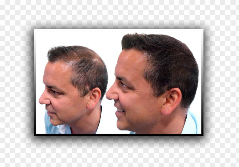 Hair Loss Nose Chin Forehead Human Behavior Jaw PNG