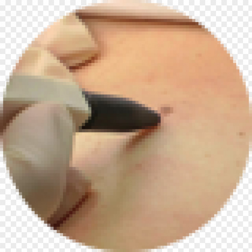 Skin Tag Wart Leicester Laser Clinic LA PNG