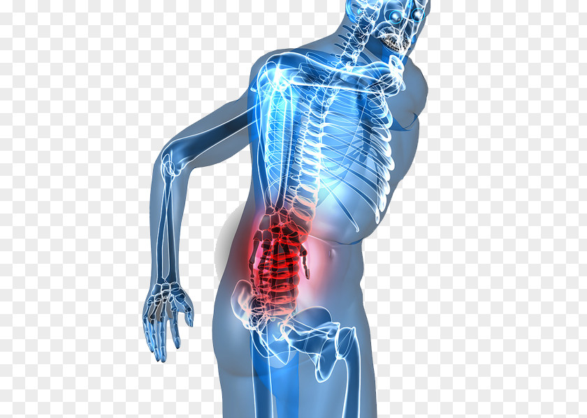 Low Back Pain Sciatica Chiropractic Chiropractor PNG