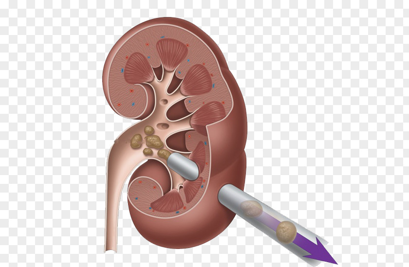 Pnl Kidney Stone Surgery Percutaneous Nephrolithotomy Ureter PNG