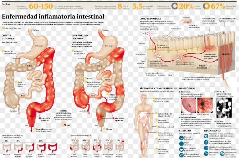 Crohns Disease Inflammatory Bowel Crohn's Ulcerative Colitis Intestine PNG