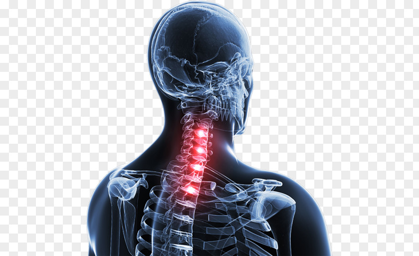Neck Pain Spinal Disc Herniation Vertebral Column Thoracic Vertebrae PNG