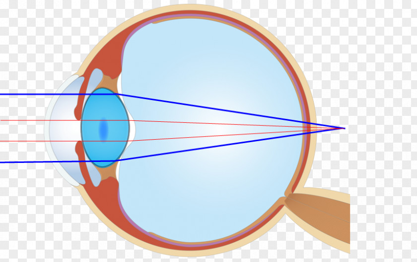 Eye 後遺障害 Ophthalmology Medical Device Contact Lenses PNG