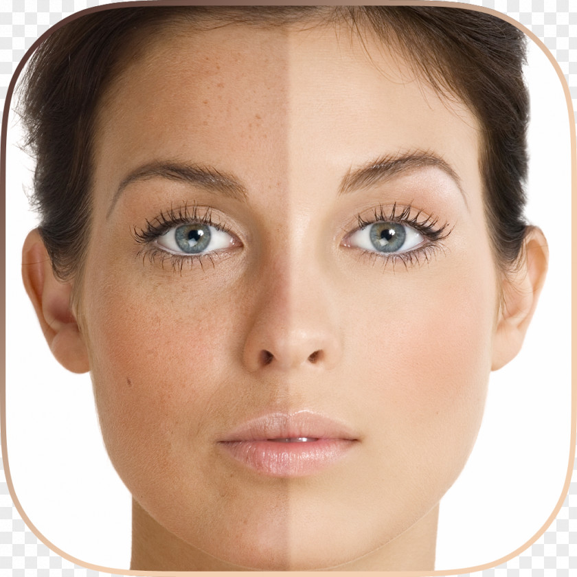 Aging Hyperpigmentation Skin Care Liver Spot Pimple PNG