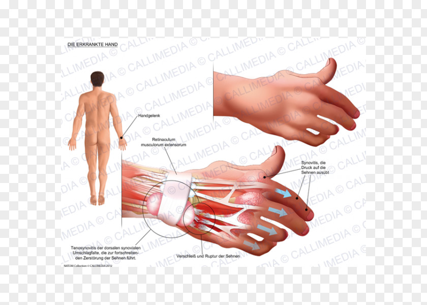 Design Thumb Product Hand Model Subcutaneous Nodules PNG
