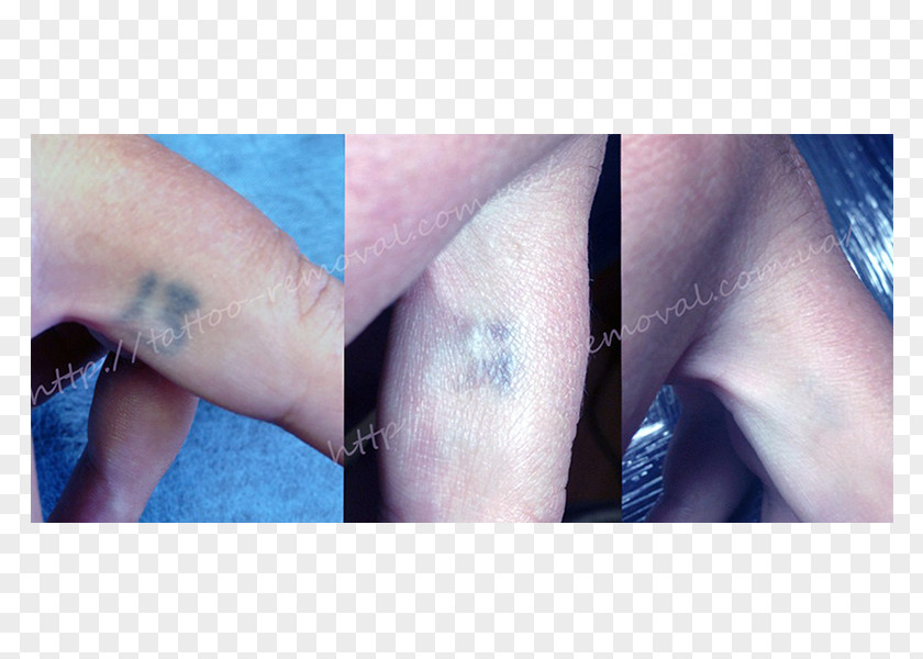 Tattoo Removal Permanent Makeup Scar Q-switching PNG