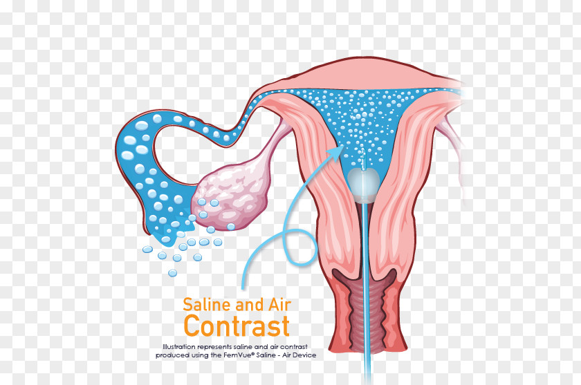 Occlusion Fallopian Tube Ultrasonography Infertility Uterus Hysterosalpingography PNG