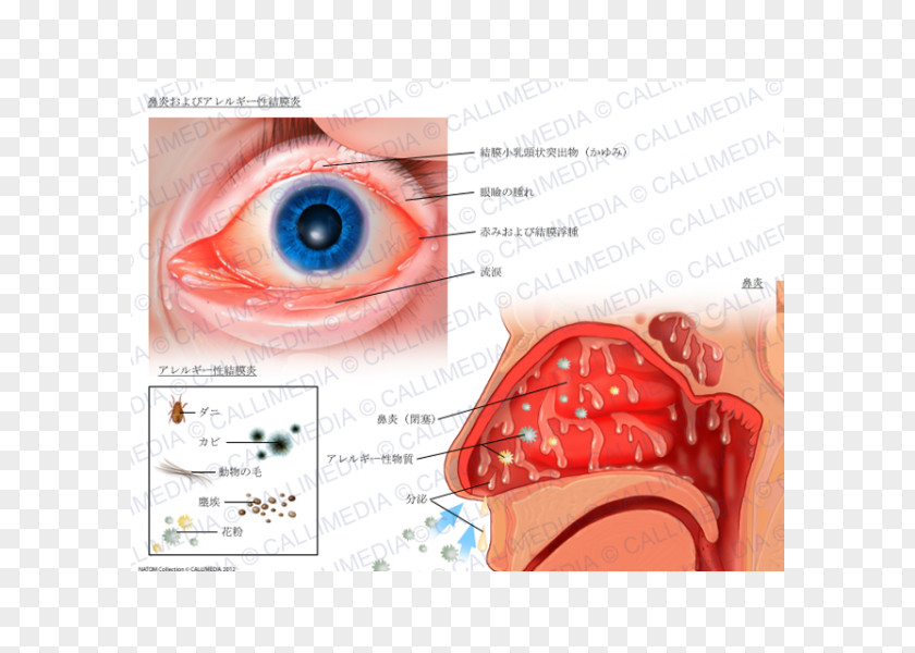 Allergy Allergic Conjunctivitis Hay Fever Rhinitis PNG