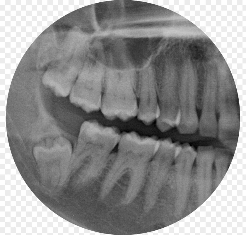 Tooth Surgery Wisdom Dental Extraction Jaw Trigeminal Nerve PNG