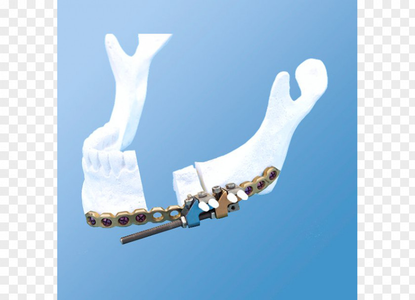 Multi Vector Mandible Distraction Osteogenesis Bone DePuy Synthes Companies PNG