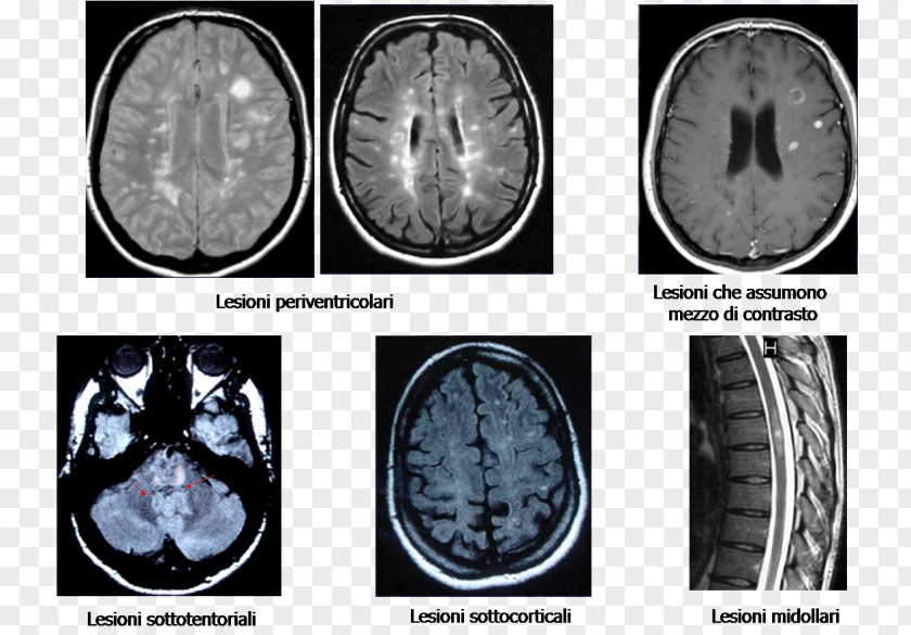 Brain Multiple Sclerosis Magnetic Resonance Imaging Disease PNG