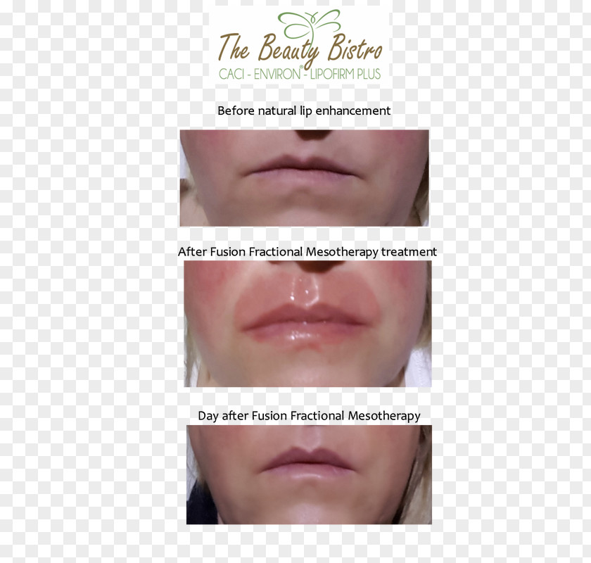 Face Mesotherapy Lip Gloss Eyelash Extensions PNG