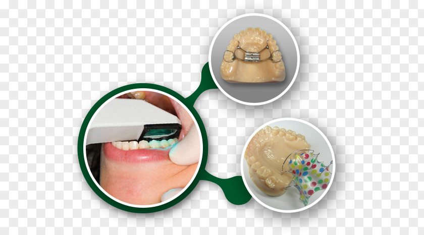 Retainer Orthodontics Laboratory Dental Braces Orthodontic Technology PNG