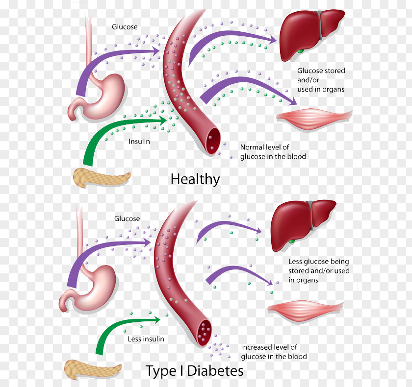 Type 1 Diabetes Mellitus 2 Insulin Resistance PNG