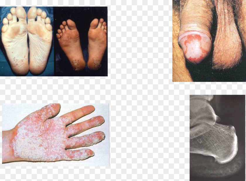 Arthritis Reactive Disease Balanitis Circinata Spondyloarthropathy PNG