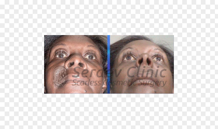Nose Snout Serdev Suture Surgical Cheek PNG