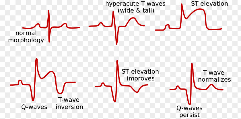 Myocardial Infarction ST Elevation Acute Segment Electrocardiography PNG