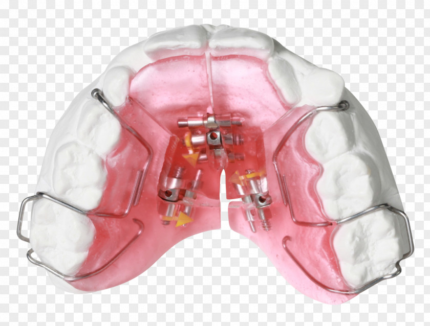 Orthodontics Gergen's Orthodontic Lab Technology Jaw Bionator PNG