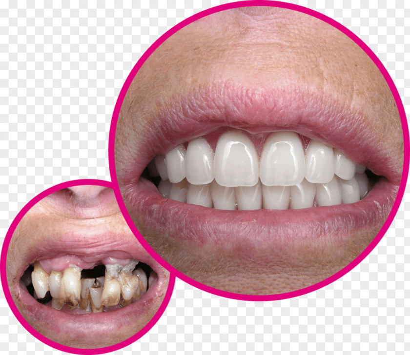 Bent Frame Tooth Bridge Crown Dentist Veneer PNG