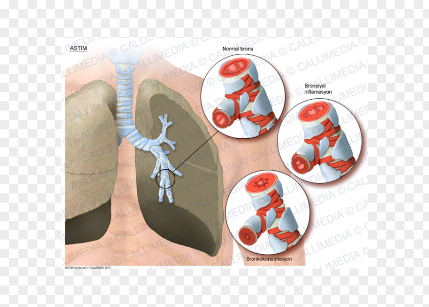 Asma Asthma Lung Bronchus Respiratory Tract PNG