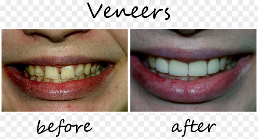 Crown Tooth Veneer Orthodontics Dentistry PNG