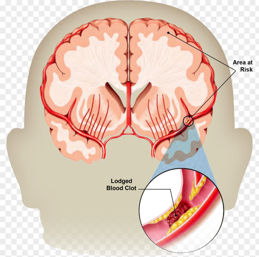 Health Stroke Transient Ischemic Attack Neurology Brain Haemorrhage PNG