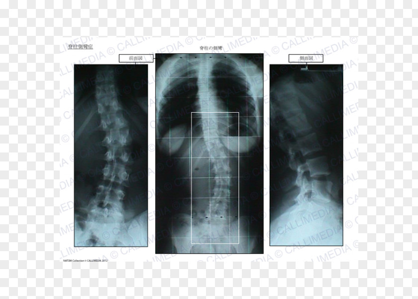 Scoliosis X-ray Radiology Medical Imaging Radiography Poster PNG