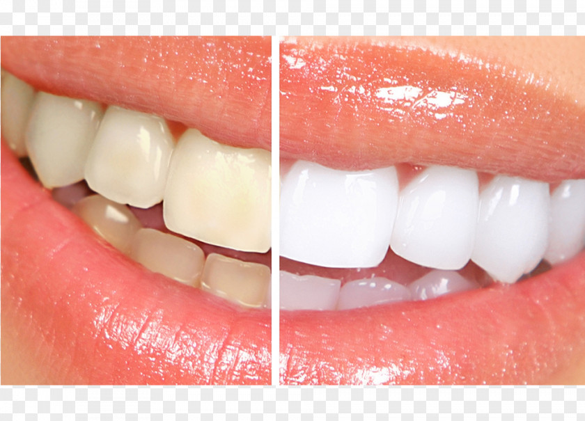 Hollywood Smile Cosmetic Dentistry Tooth Whitening PNG