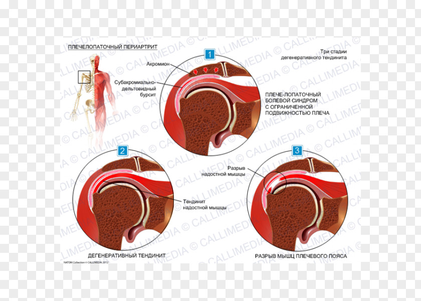 Scapula Adhesive Capsulitis Of Shoulder Periartrite Scapolo-omerale Periarthritis Rheumatology PNG