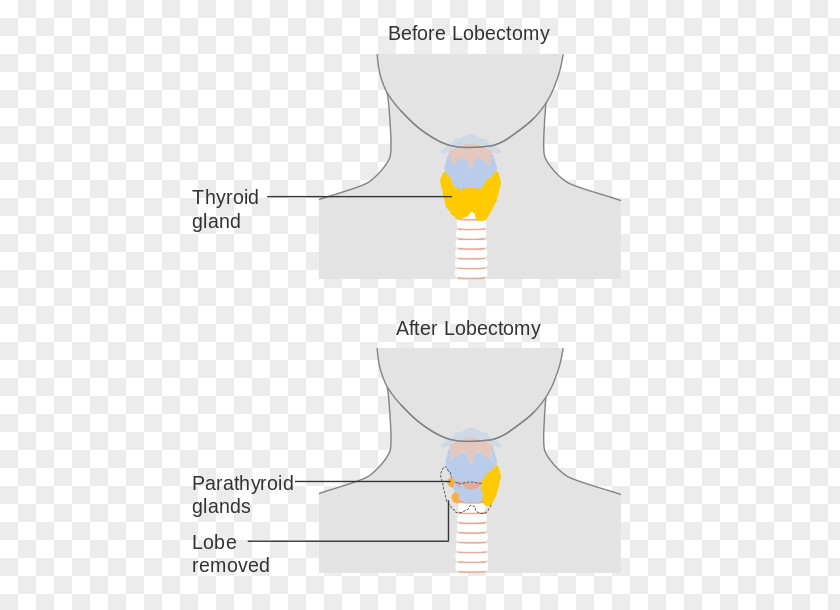 Thyroid Thyroidectomy Lobectomy Surgery Cancer PNG