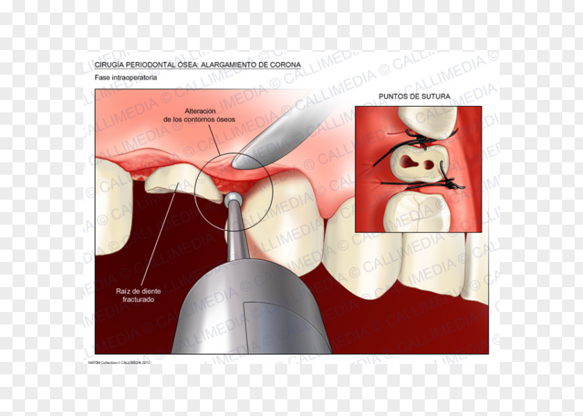 Crown Lengthening Surgery Periodontal Disease Tooth PNG