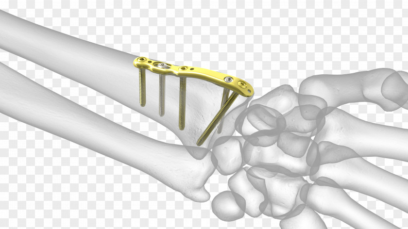 Radial Styloid Process Thumb Distal Radius Fracture Ulnar PNG