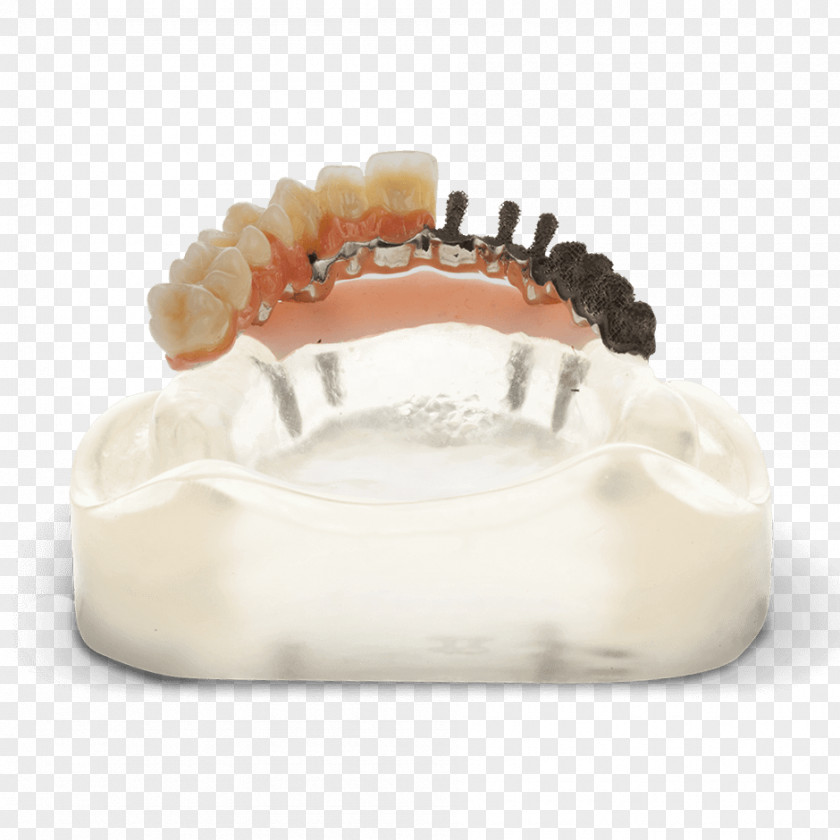 3d Tooth Repair Dentistry Bridge Dentures Dental Implant PNG