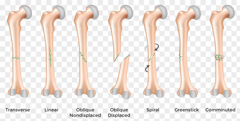 Bones Bone Fracture Healing Femoral Injury PNG