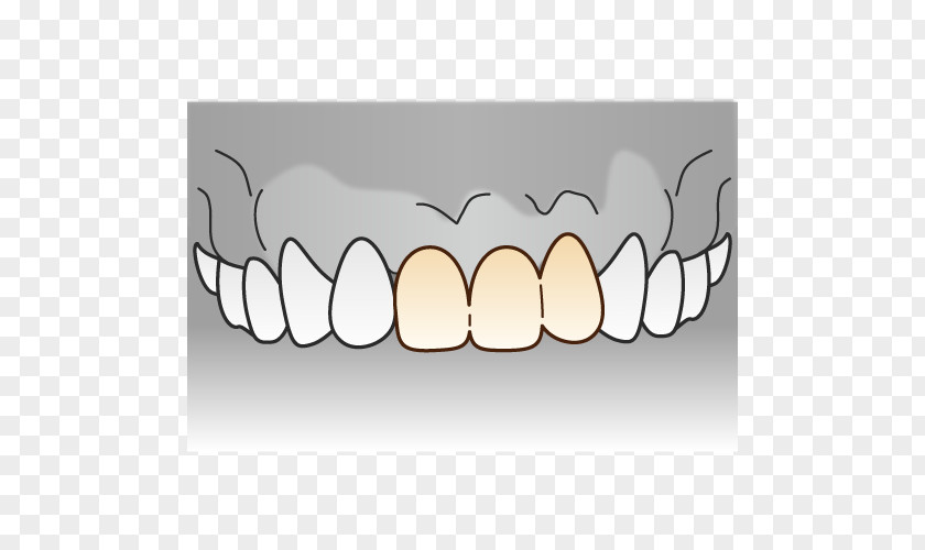 Bridge Tooth Dentist Dentures 審美歯科 PNG