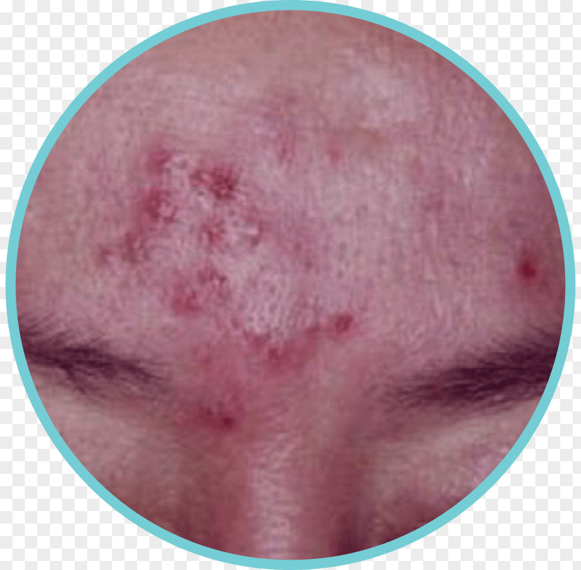 Acne Disease Scar After Image 1 Therapy PNG