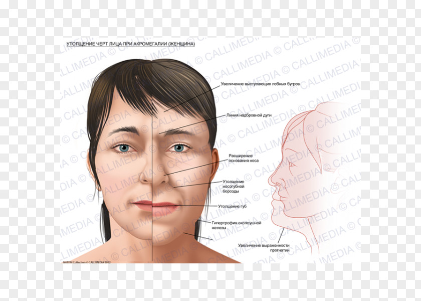 Face Acromegaly Gigantism Growth Hormone PNG