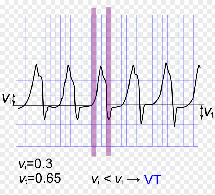 QRS Complex Ventricular Tachycardia Algorithm Bundle Branch Block Electrocardiography PNG