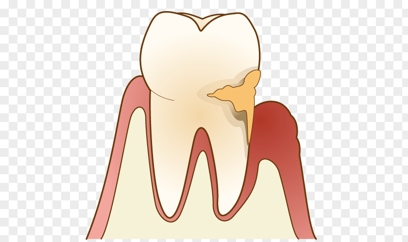 Toothbrush Periodontal Disease Gums 歯科 Dentist Dental Plaque PNG