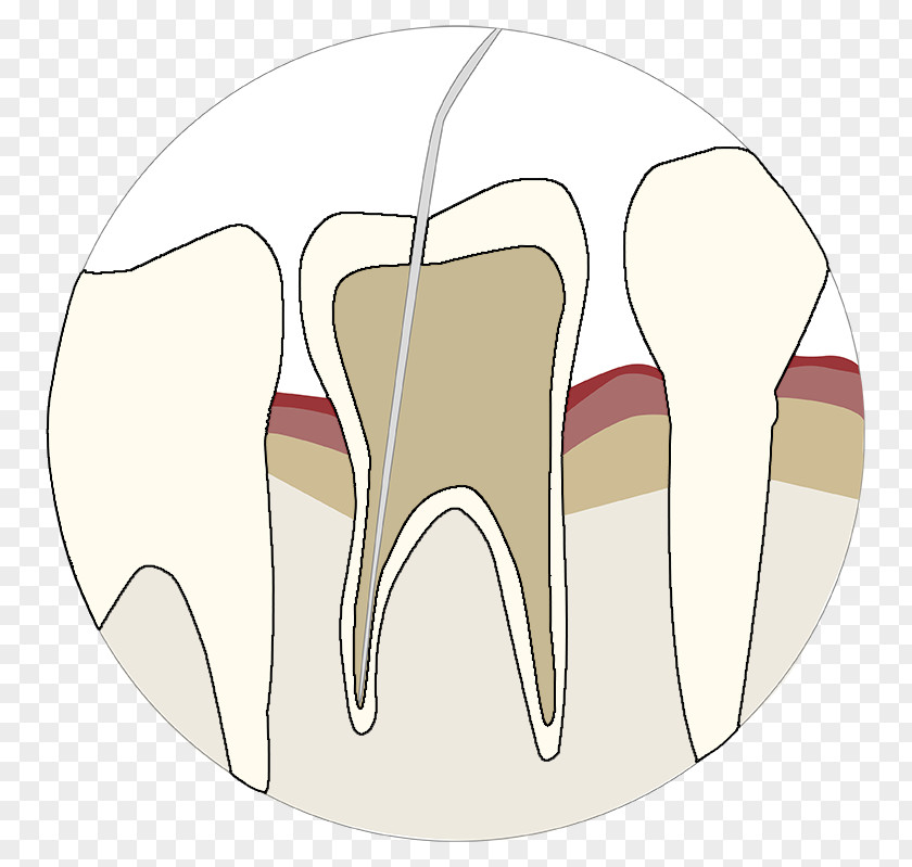Endodontic Tooth Velopex International Dentistry Air-Polishing Endodontics PNG