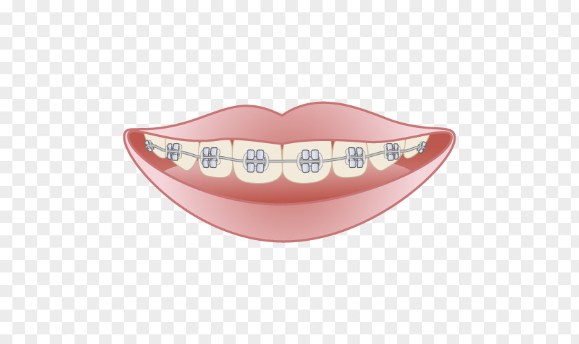 O 矯正歯科 Dentist Dental Braces Mouthguard Damon System PNG