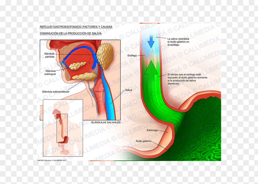 Gastroesophageal Reflux Disease Esophagus Saliva Gastro- Cough PNG