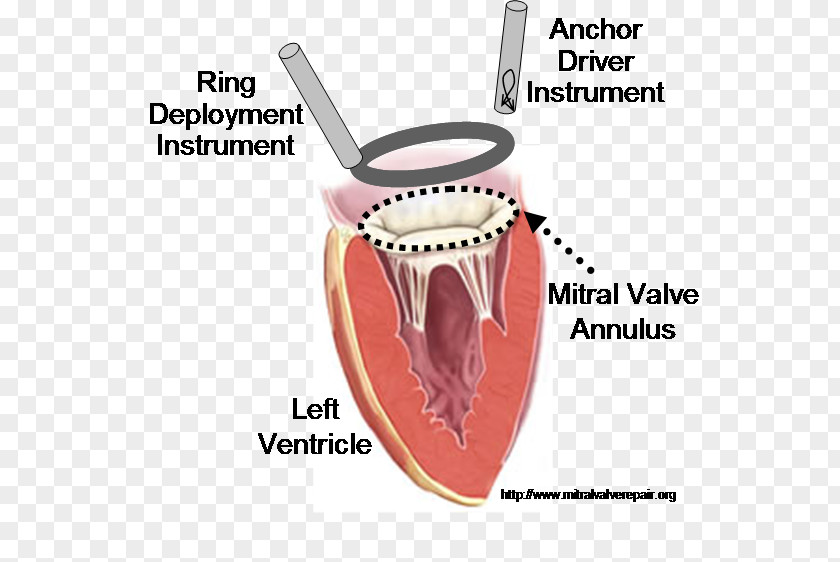 Heart Mitral Valve Annuloplasty Repair PNG